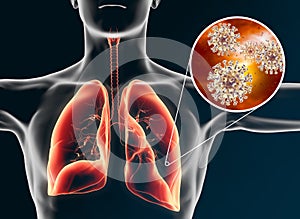 Coronavirus in human lungs;pneumonia, 3D illustration