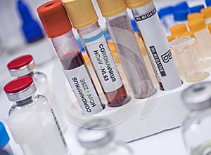 Coronavirus sample in laboratory