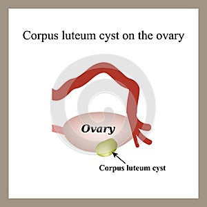 Corpus luteum cyst on the ovary. Functional cyst. photo