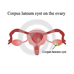 Corpus luteum cyst on the ovary. Functional cyst. Ovary. photo