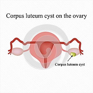 Corpus luteum cyst on the ovary. Functional . . Infographics. Vector illustration photo