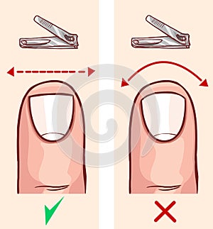 Correct and incorrect fingernail cut
