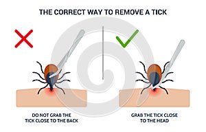 The correct way to remove a tick insect correctly. Infographic tips for tick safety