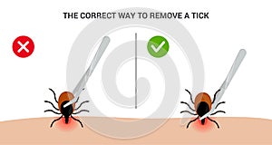 The correct way to remove a tick insect correctly. Tips for tick safety infographic