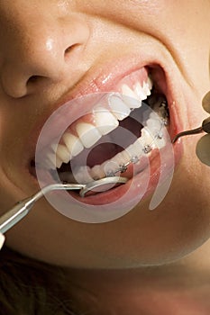 Correcting device on teeth