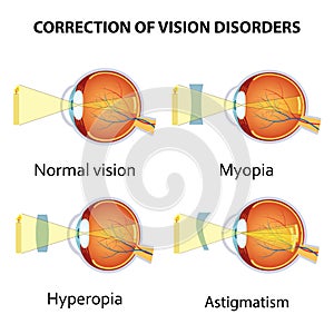 Correction of eye vision disorders by lens. photo