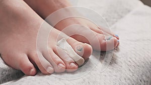 Correction of ingrown toenail. Female feet with silicone fixator between toe fingers. Closeup. Pan shot. The concept of