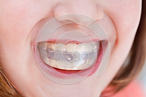 Correction of occlusion by orthodontic trainer photo