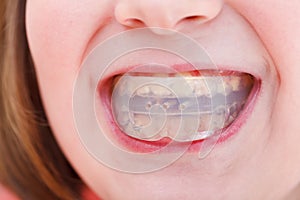 Correction of occlusion by orthodontic trainer photo