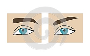 Correction of shape of  eyebrows before and after