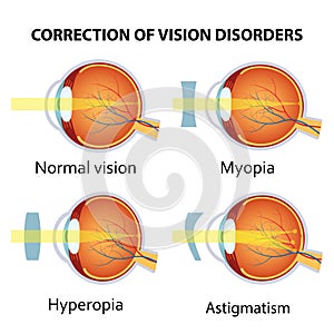 Correction of various eye vision disorder. photo