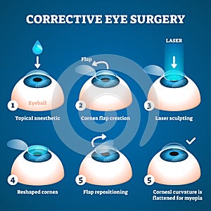 Corrective eye surgery vector illustration. Laser process education scheme.