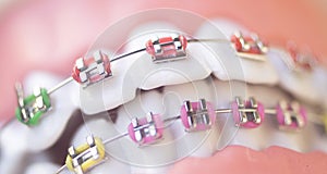 Cosmetic dental metal brackets