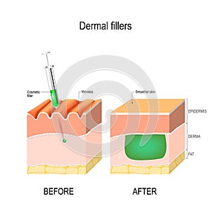 Cosmetic or dermal filler. Before and after injection.