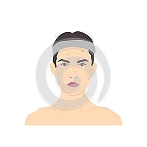 Cosmetic face care, sad woman with pimples, rash or acne, vector isolated on white background.