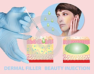 Cosmetic filler or dermal fillers