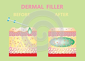 Cosmetic filler or dermal fillers