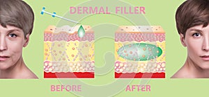 Cosmetic filler or dermal fillers