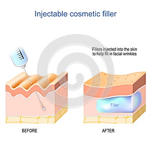 Cosmetic filler injectable. Skin with wrinkles before and after photo
