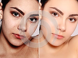 Before and after cosmetic operation. Young pretty woman portrait