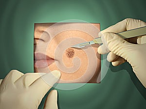 3D-Darstellung eines Chirurgen zu entfernen, ein Maulwurf.