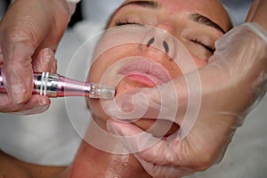 Anti-aging care with dermapen, patient face close-up photo