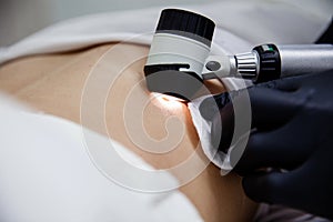 A cosmetologist doctor in black gloves examines the patient& x27;s mole using a dermatoscope. Close-up