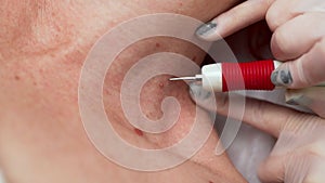 Cosmetologist removing small papilloma using laser on woman's neck, burning skin, closeup view. Surgical procedure