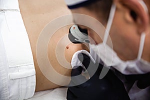 A cosmetologist in a white cap and black gloves examines a mole on the patient& x27;s back using a dermatoscope