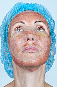 Cosmetology. Chemical peeling.Portrait