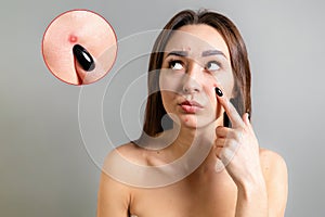 Cosmetology, Dermatology and acne. A young Caucasian brunette points to a pimple on her face. Gray background. Zoom circle shows