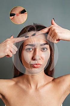 Cosmetology, Dermatology and acne. A young Caucasian brunette squeezes out a pimple on her forehead. Gray background. Copy space.