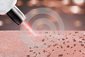 Cosmetology procedure laser freckle skin removal on body parts.