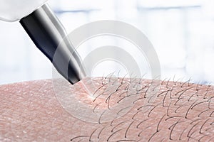 Kozmetológie postup laserový lúč vlasy odstránenie na telo. laserový lúč epilácia 