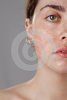 Cosmetology and rosacea. Portrait of half the face of a young woman with freckles and a faint rosacea on her cheeks