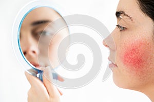 Couperose. Young beautiful Caucasian woman with rosacea on her cheek looking at the mirror. Isolated on a white photo