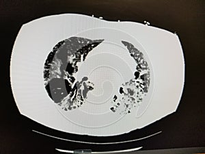 COVID-19 CT Scan of the Chest in patient with emphysema