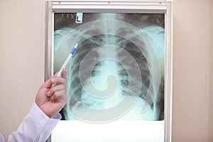 COVID-19, coronavirus or bone cancer illness with radiological chest x-ray film for medical healthcare hospital , Doctor diagnosin photo