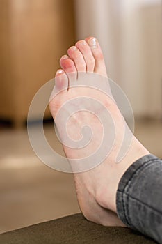 Covid toes. Coronavirus symptoms - swelling and discoloration, purplish color, pain and rough skin