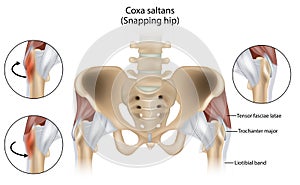 Coxa Saltans or Snapping Hip Snapping Hip Syndrome also referred to as dancer hip.