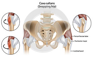 Coxa Saltans or Snapping Hip Snapping Hip Syndrome also referred to as dancer hip. photo