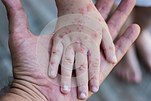 Coxsackie virus. Child with a skin rash.
