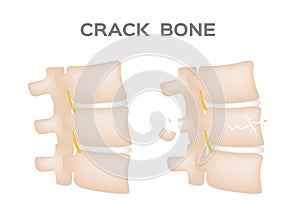 Crack bone spine / broken and damaged disc 