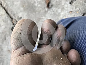 Cracked heels on fingers of left legs which needs medications