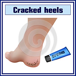 Cracked heels. Foot diseases. Dermatology.