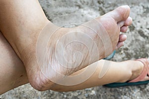 Cracked heels and foot with dry skin of woman from dirty. Concept treatment skin care foot and medical podiatrist.