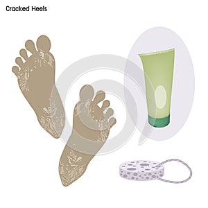 Cracked Heels with Prevention and Spa Treatment