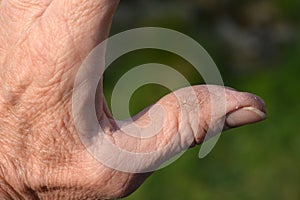 Cracked skin on a workman's hand