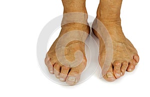 Cracked toe and bunion deformity