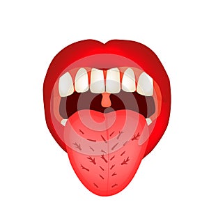 Cracks in the tongue. Definition of a disease according to human tongue. Diagnostics by tongue. Tongue Vector